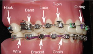 The Orthoevolution of Orthodontic Archwires